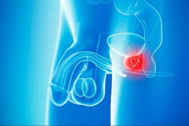 Что делать человеку, если у него обнаружен рак предстательной железы?